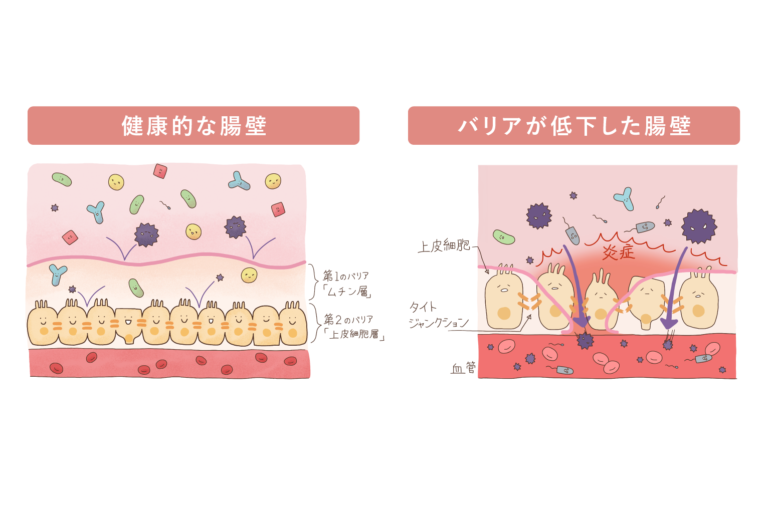 腸壁のバリア構造と炎症を示すイラスト